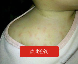 濕 疹