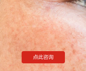 其它皮膚病