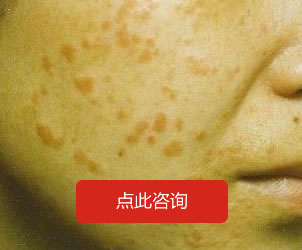 扁平疣