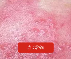 帶狀皰疹