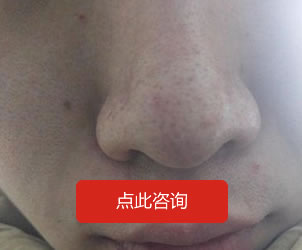 酒糟鼻
