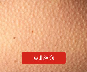 毛周角化