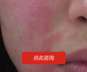 面部皮炎