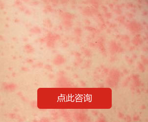 皮膚過(guò)敏