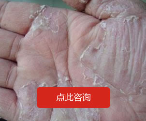 手足癬