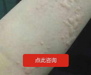 蕁麻疹