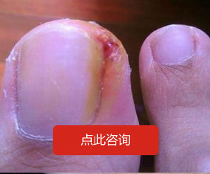 甲溝炎